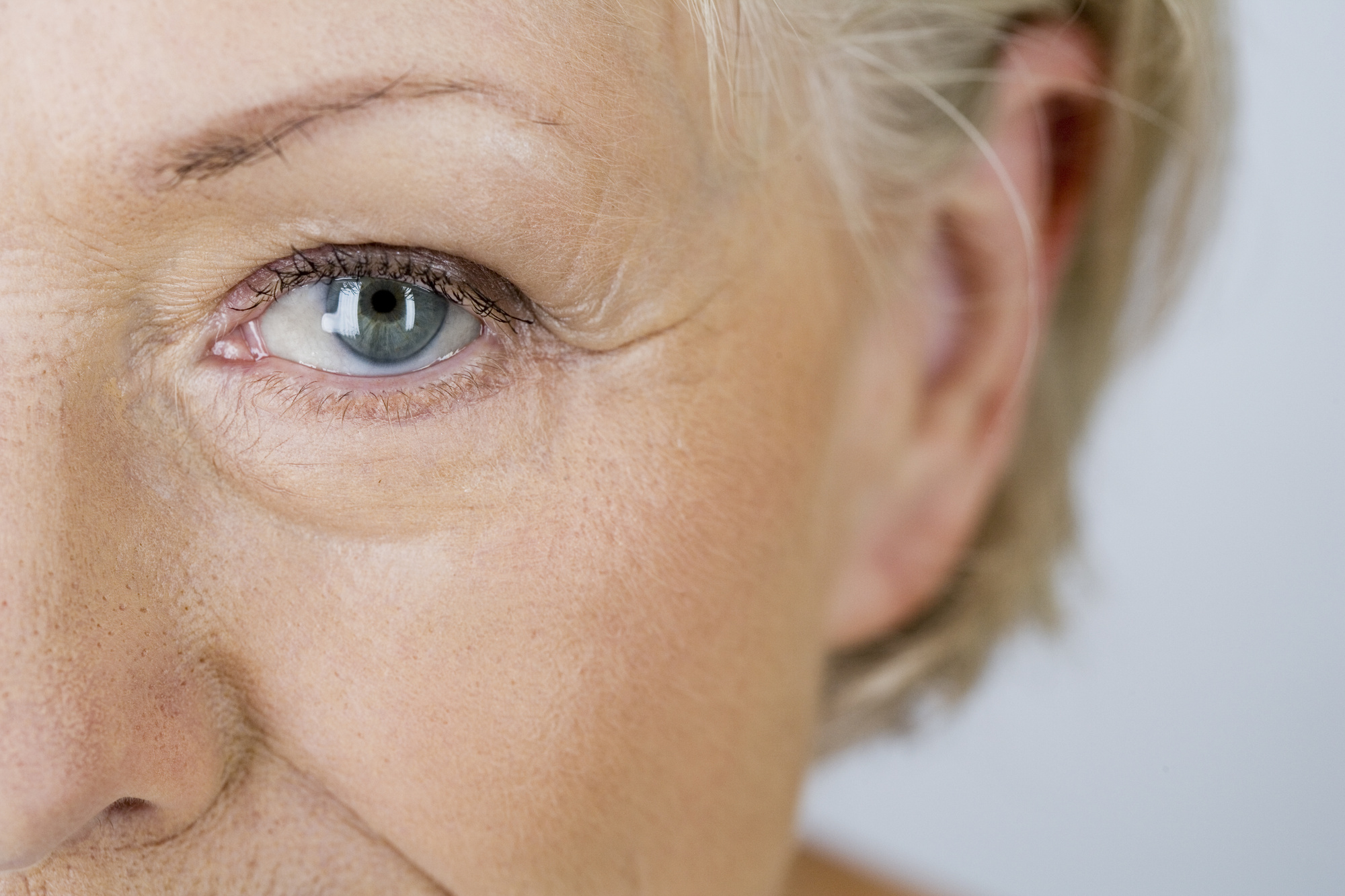 Botox Crows Feet Treatment