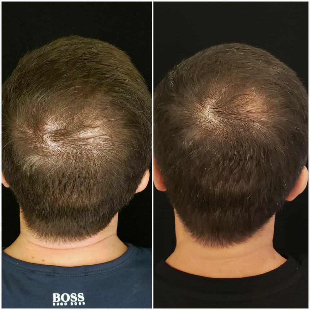 PRP Hair Restoration: How Does It Work, and Is It Permanent? - My Botox LA  Med Spa News & Articles