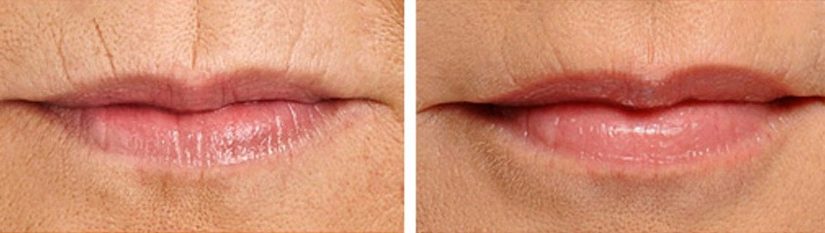 BEST TREATMENT FOR LIP LINES