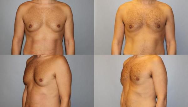 CoolSculpting For Men - Man Boobs and Gynecomastia - My Botox LA Med Spa  News & Articles