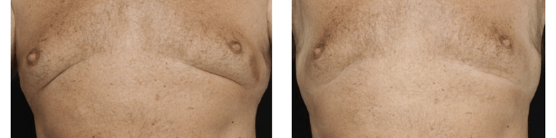 coolsculpting gynecomastia