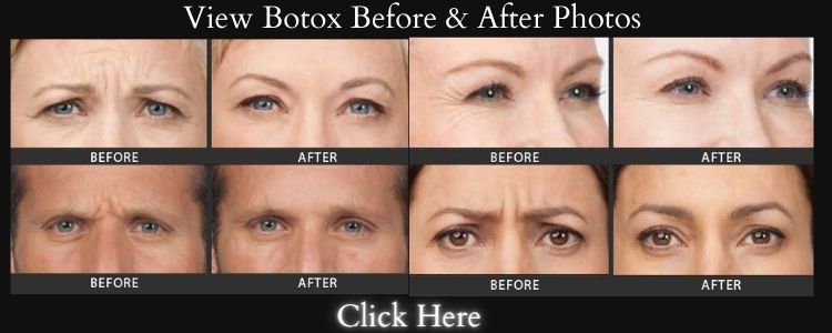 Botox Los Angeles Before & After Photos