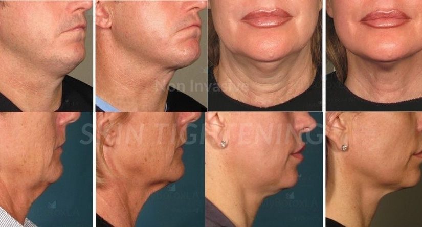 Non Invasive Skin Tightening Los Angeles