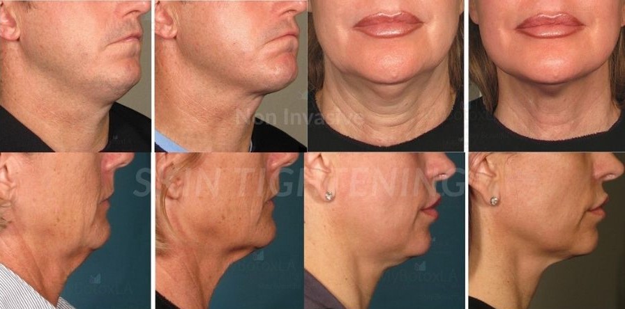 The Best Non Surgical Skin Tightening Treatment For Face And Body My 