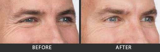 Botox Crows Feet Treatment Men