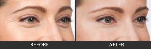 Botox Crows Feet Treatment