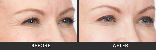 Botox Crows Feet Treatment