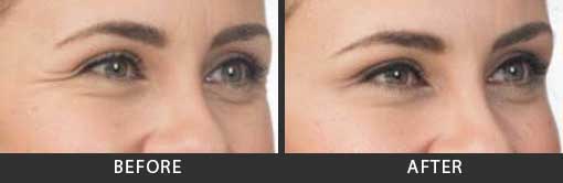 Botox Crows Feet Treatment Woman