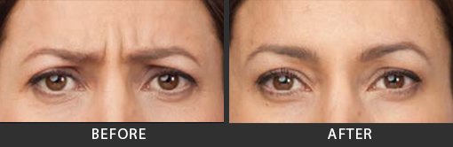 Botox Before and After Photos Botox Before and After Photos