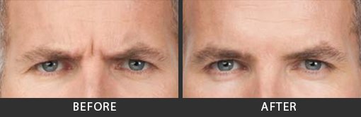 About Botox Santa Monica - Best Prices On Botox Near Me In Los ... thumbnail