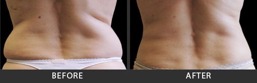 before and after coolsculpting at My Botox LA Med Spa
