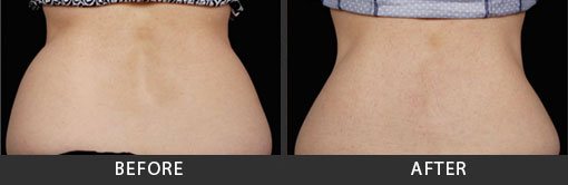 Coolsculpting My Botox LA Med Spa