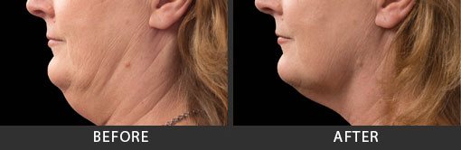 My Botox LA Med Spa coolsculpting