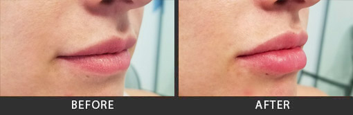 Before and After Photo