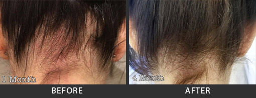 Prp Hair Treatment Los Angeles Prp For Hair Loss Studio City