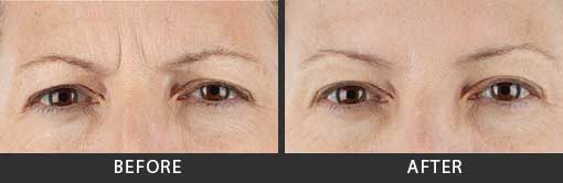 Xeomin Injections Before and After Photos